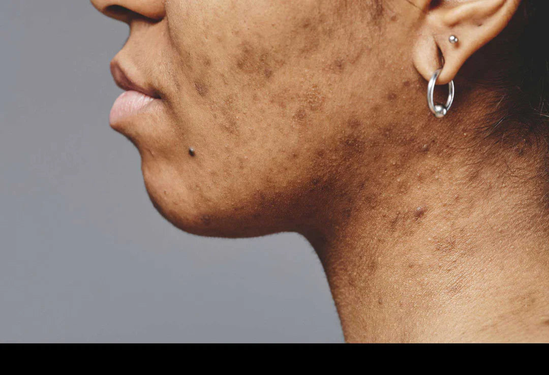 Taches noires sur peau noire : causes, prévention et soins adaptés